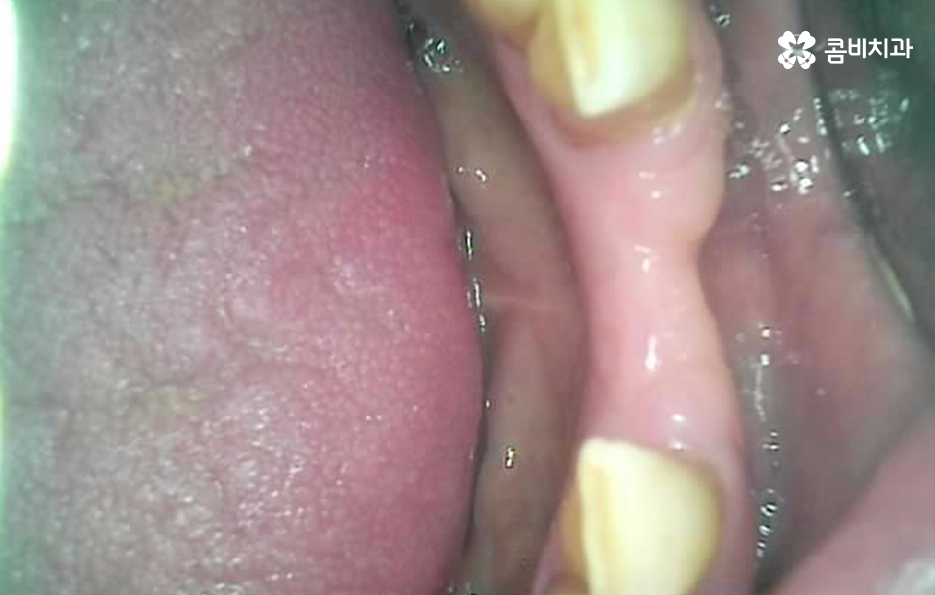 50대임플란트 각별하게 주의해야 하는 시기 관련 이미지 5