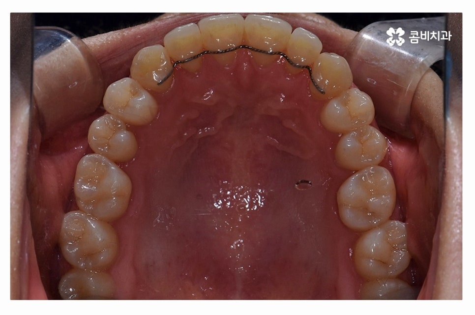 덧니교정 체계적으로 준비하려면 관련 이미지 13