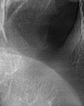 어금니 뒤 잇몸 부음 어떤 문제길래 이런거죠 관련 이미지 26