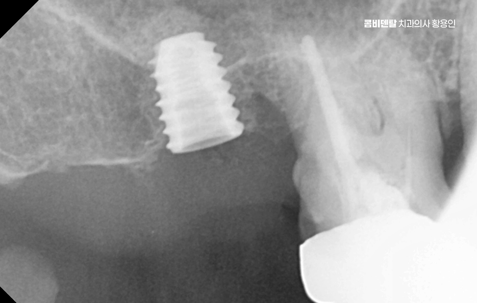 치아 발치 후 임플란트 언제부터 준비할까 관련 이미지 4