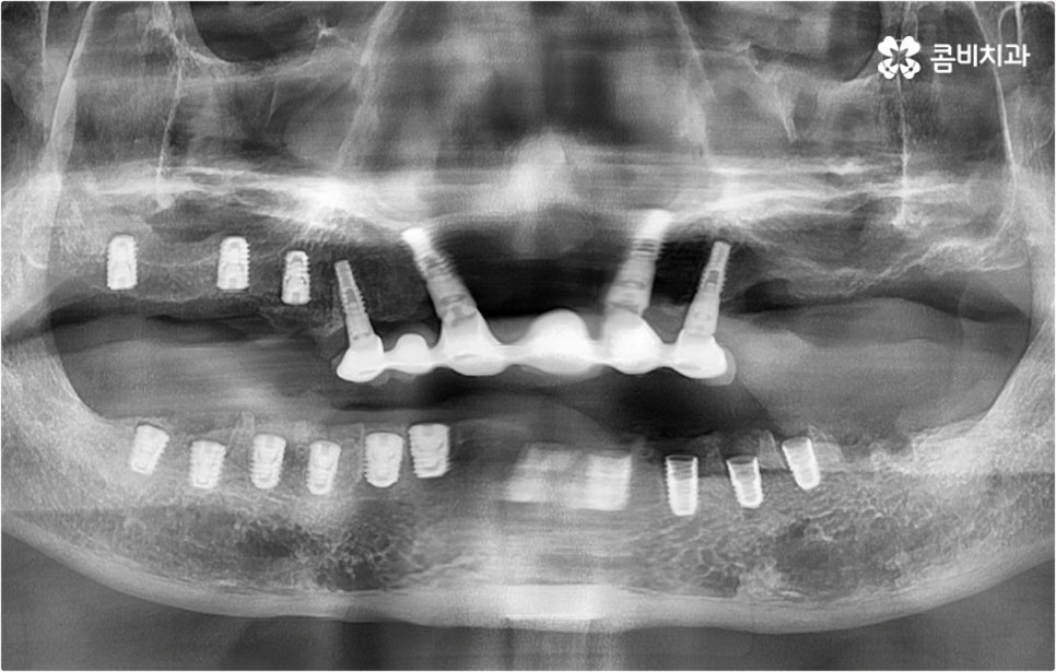 전악임플란트 고려할 사항들은 관련 이미지 11