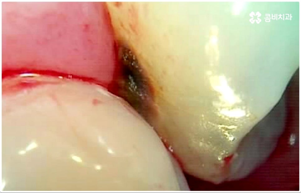 치아사이충치 놔두면 안돼요 관련 이미지 1