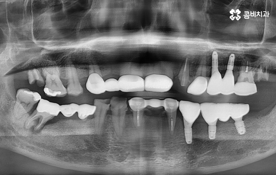 임플란트 치조골 상태에 따라 치료 계획도 달라지나요 관련 이미지 8