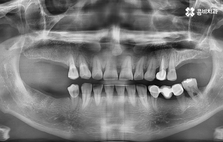 40대임플란트 치과에 이건 알고 가세요 관련 이미지 1