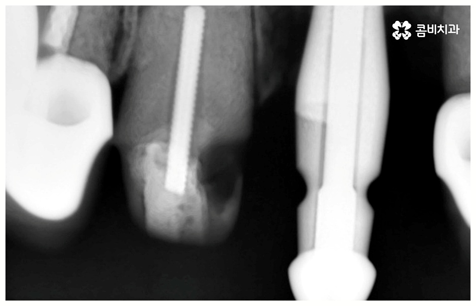임플란트 치료기간 중점을 두어야 할것은 관련 이미지 7