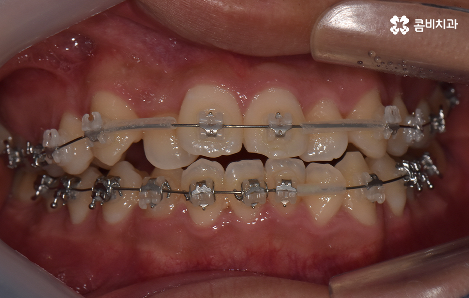 30대 치아교정 빨리 끝내고 싶어요 관련 이미지 6