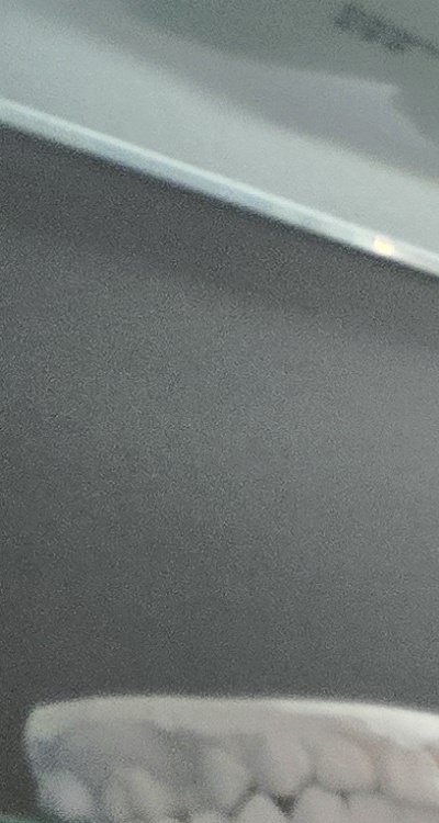 완전매복사랑니 발치 대학병원 꼭 가야하나요 관련 이미지 9