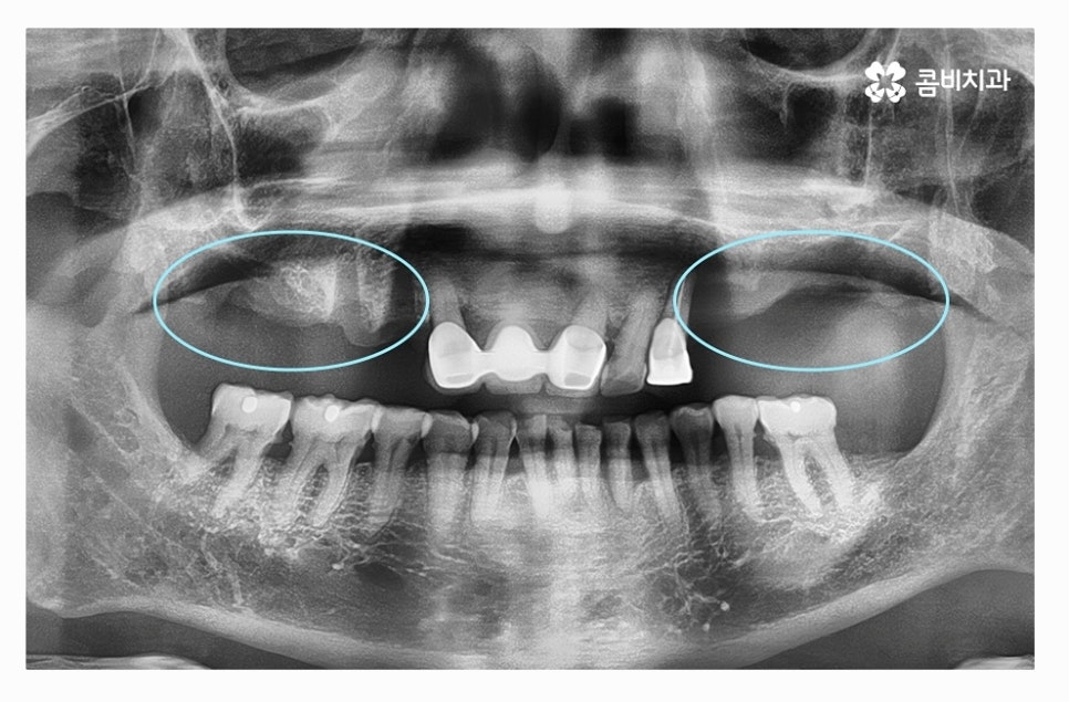 전체임플란트 신중하게 결정하려면 관련 이미지 2