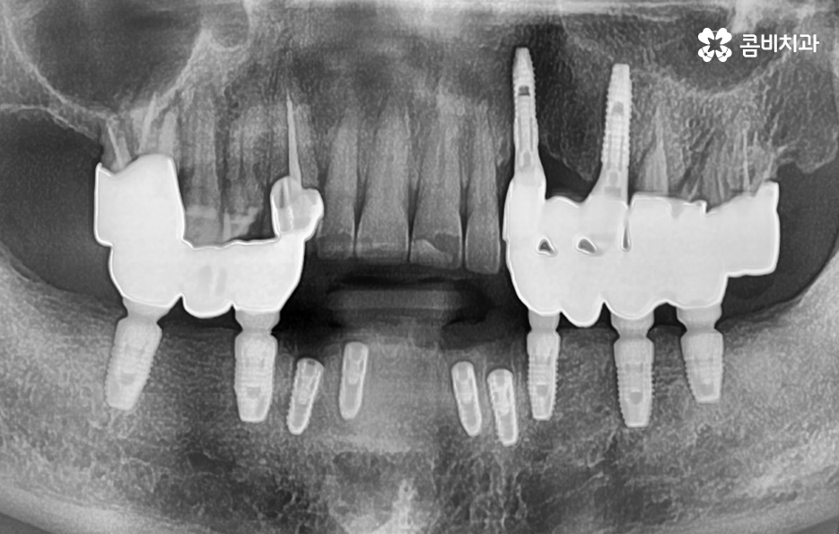발치후 임플란트 기간 현실적으로 알아보면 관련 이미지 7