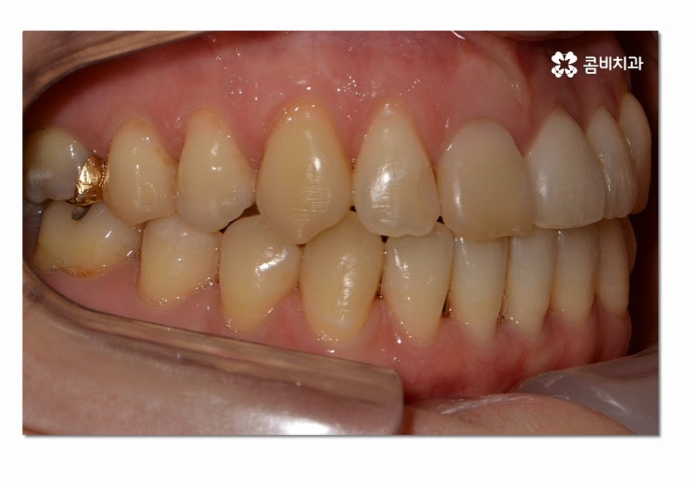 3급 부정교합 지금이라도 고치고 싶다면 관련 이미지 13