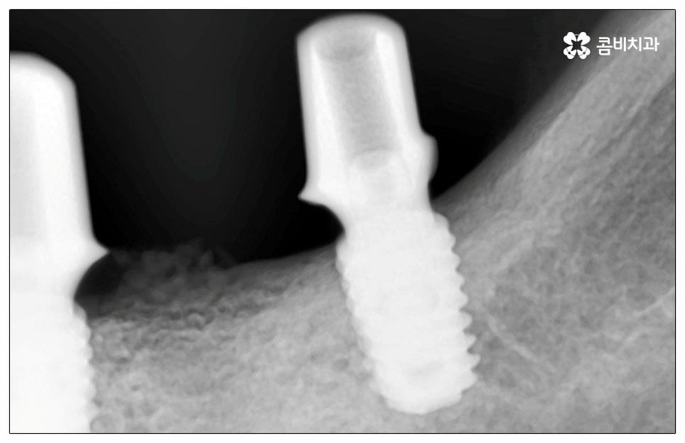 건강보험임플란트 혜택받아 보세요 관련 이미지 8