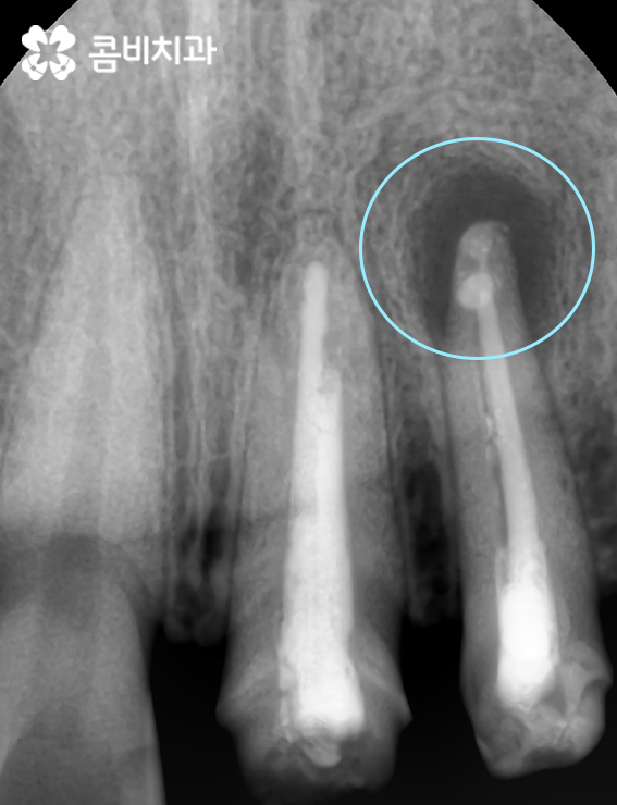 앞니 신경치료 치근단 염증이 발생한 사례 관련 이미지 3