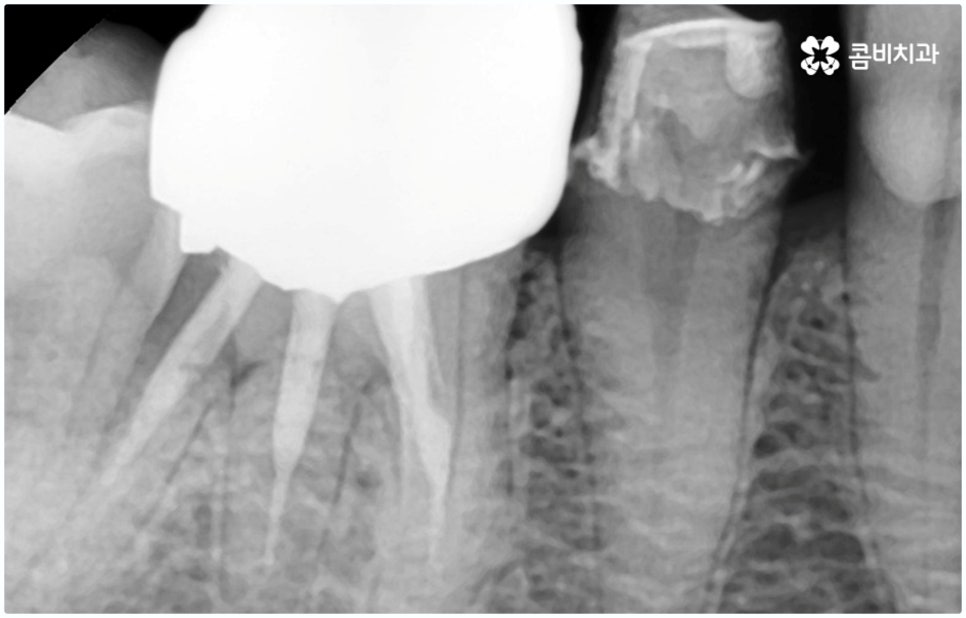 원데이임플란트 받고 싶으신가요? 관련 이미지 2