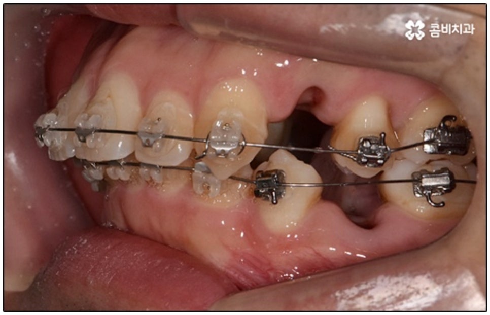 클리피씨교정 알아봐야 할것들 관련 이미지 5