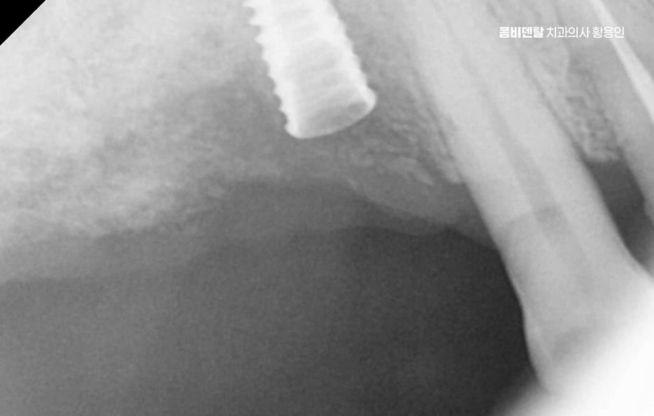 어금니 임플란트 과정 제대로 이해하려면 관련 이미지 6