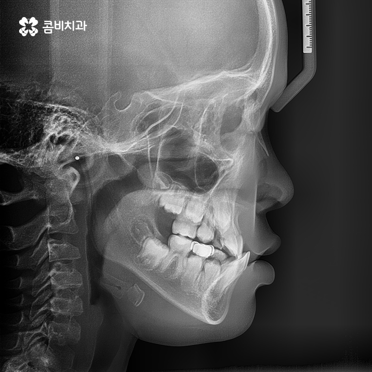 성장기치아교정 어떻게 접근하는 것이 좋을까 관련 이미지 1