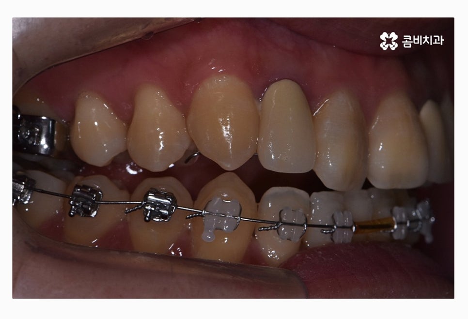 콤비교정 올바르게 판단하려면 관련 이미지 7