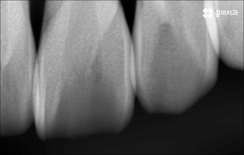 앞니 돌출 어떻게 고치나요? 관련 이미지 11