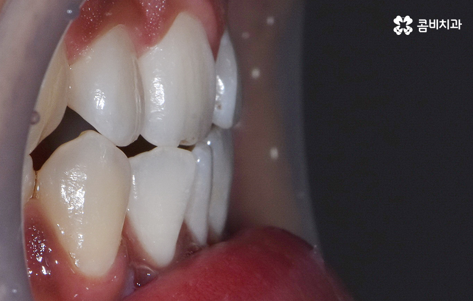 성인 부정교합 교정 더는 미루고 싶지 않다면 관련 이미지 1