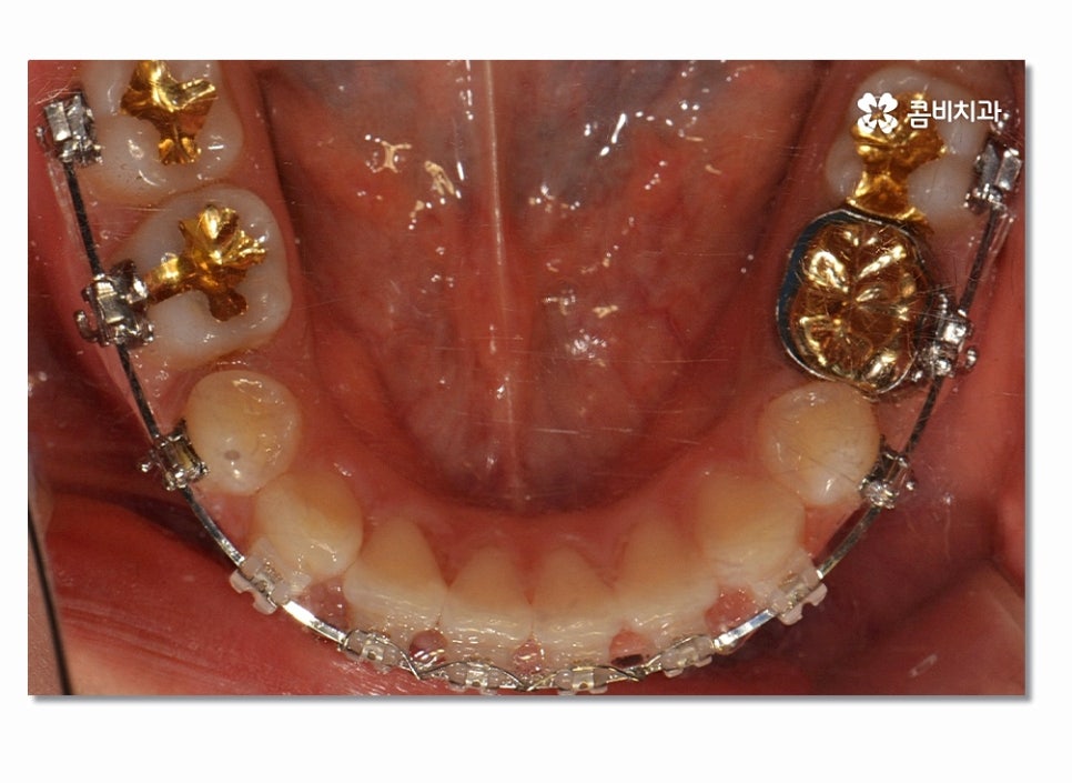 돌출입치아교정 부담이 크게 느껴진다면 관련 이미지 10