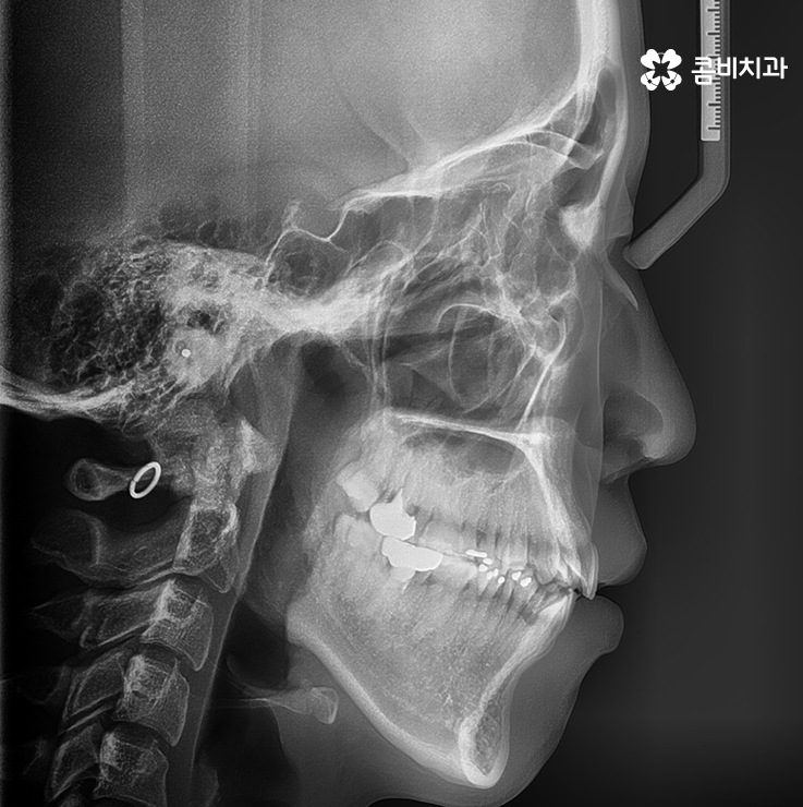 클리피씨교정 알아볼 때 꼭 신경 써야 하는 점은! 관련 이미지 5