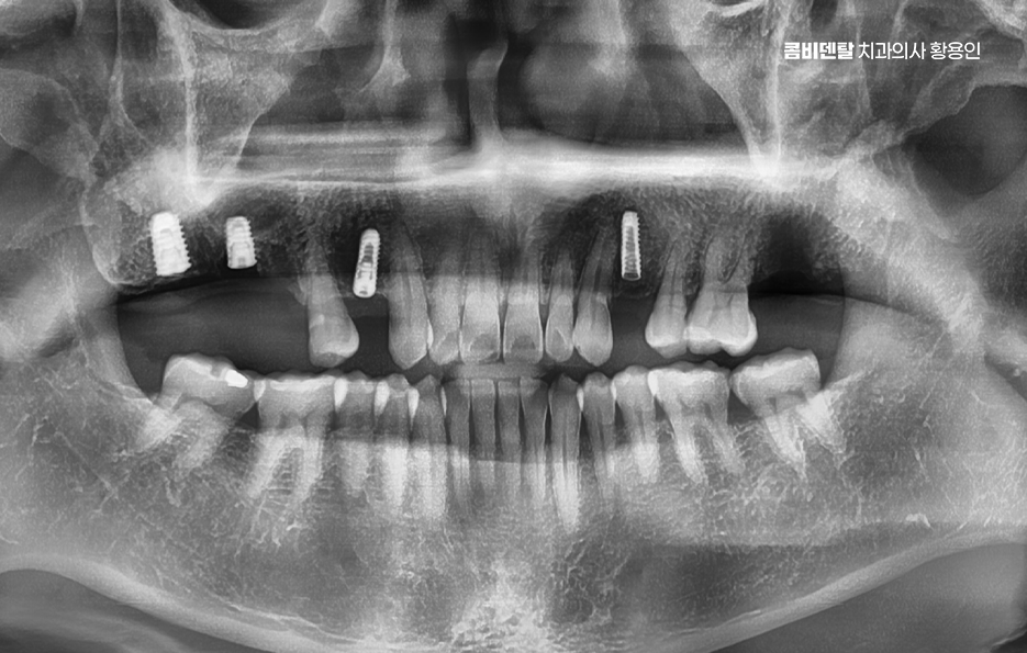 어금니 없으면 얼굴 발음에 어느정도나 안좋을까 관련 이미지 9