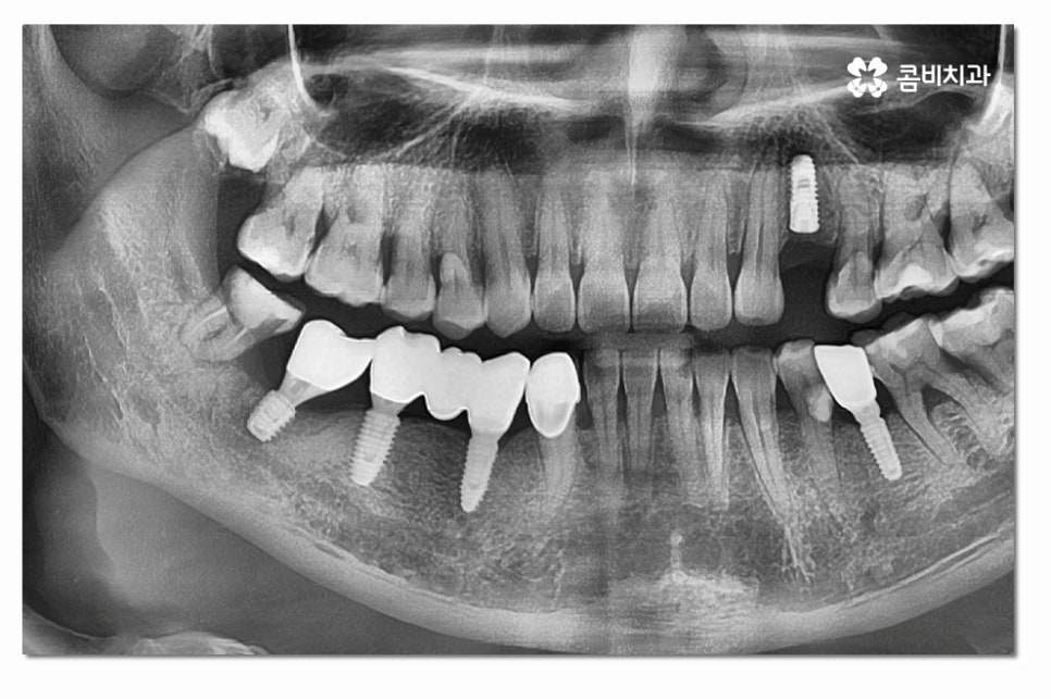 어금니임플란트 합리적으로 알아보려면 관련 이미지 7