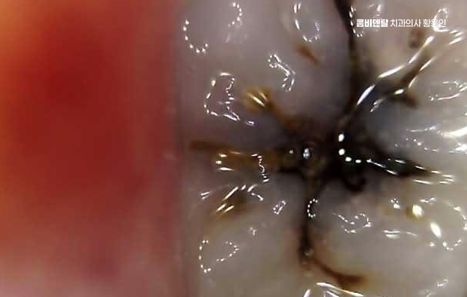 신경치료 아픈가요 망설이시는 분들이라면 관련 이미지 6