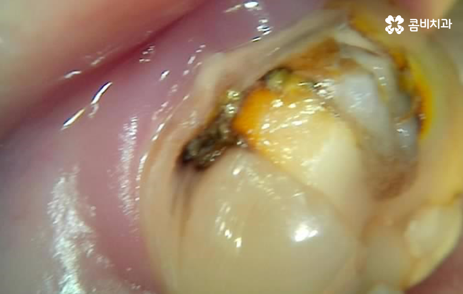 명동치과 놓치기 쉬운 2차충치에 주의하려면 관련 이미지 6