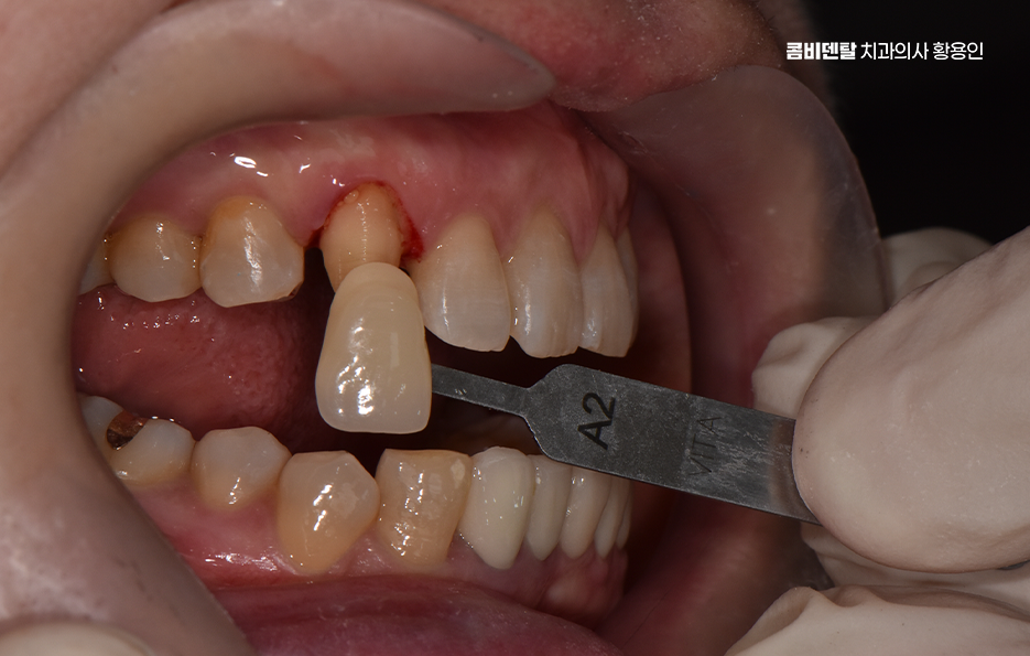 송곳니 크라운 티가 안나게 해결 가능한건가요 관련 이미지 4