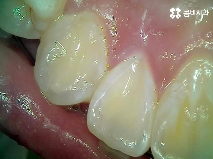 앞니 충치치료 개인에 따라 달라지는 이유 관련 이미지 8