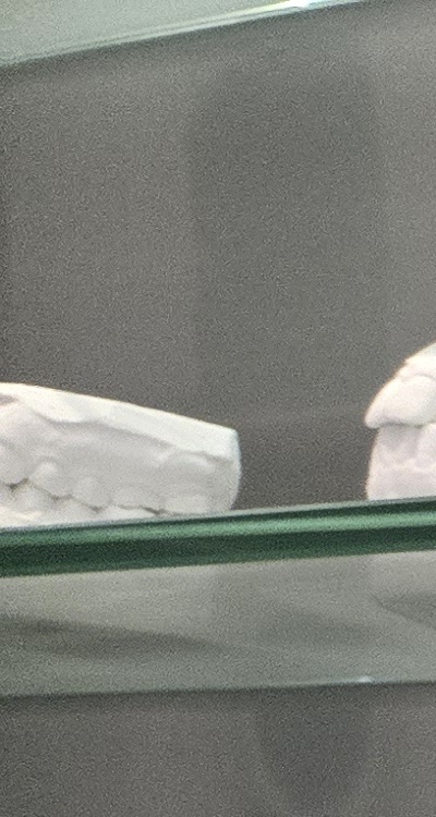 윗니 전체 임플란트 뭐부터 해야할까 관련 이미지 10