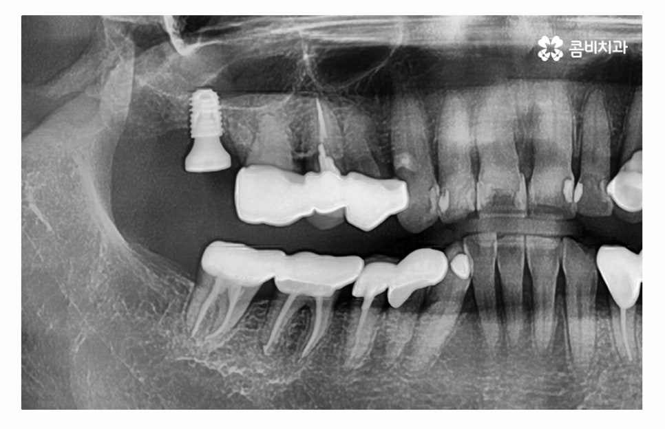 임플란트수술 제대로 알고 선택하려면 관련 이미지 8