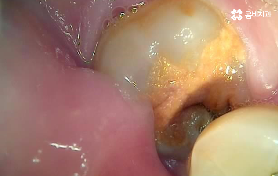 누워있는 사랑니 꼭 뽑아야 하는 경우는 언제일까 관련 이미지 8