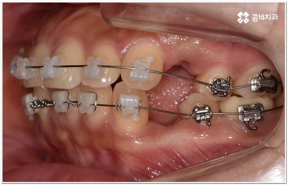 돌출입교정치과 알아보는 기준은 관련 이미지 9