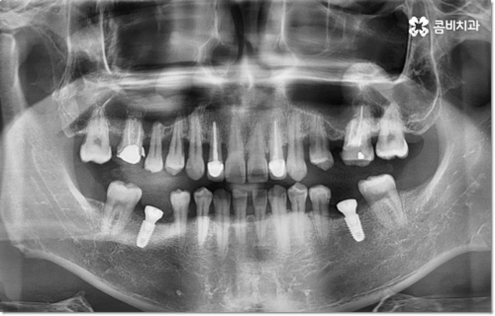 아랫니임플란트 주의할것들은? 관련 이미지 5