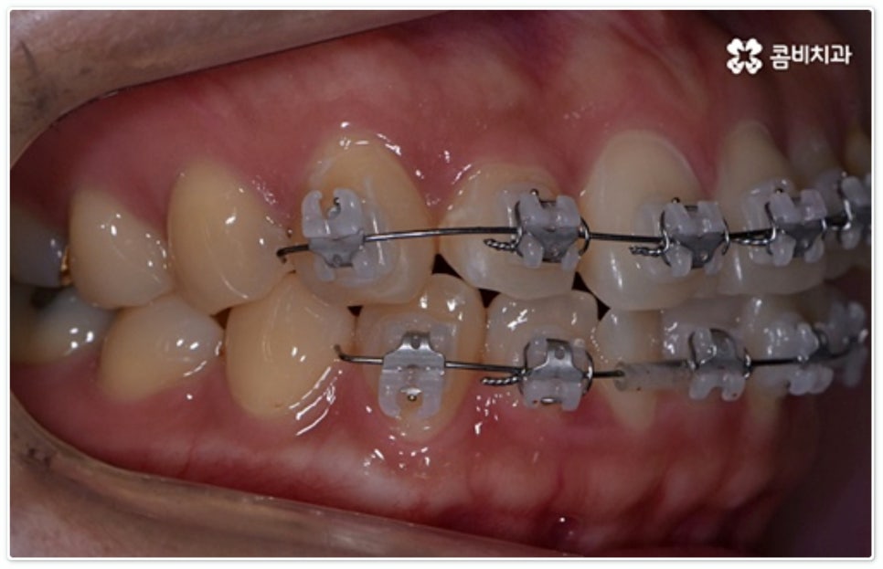 앞니부분교정 누구나 할수있나요? 관련 이미지 7