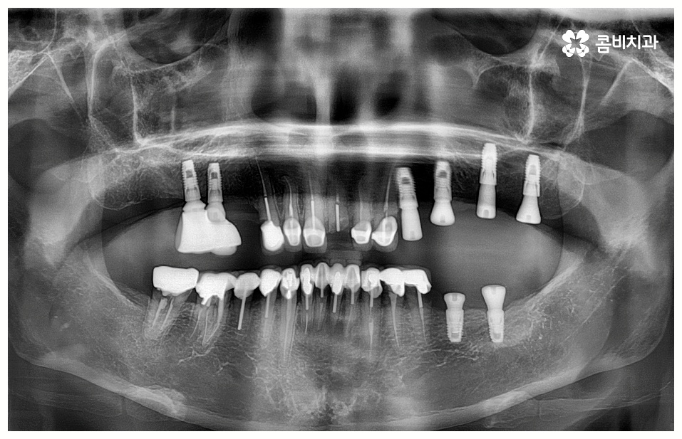 임플란트 치료기간 중점을 두어야 할것은 관련 이미지 3