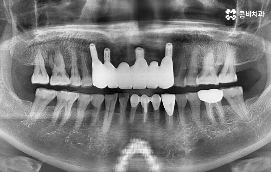 앞니임플란트 이런 조건들을 따져보세요 관련 이미지 8