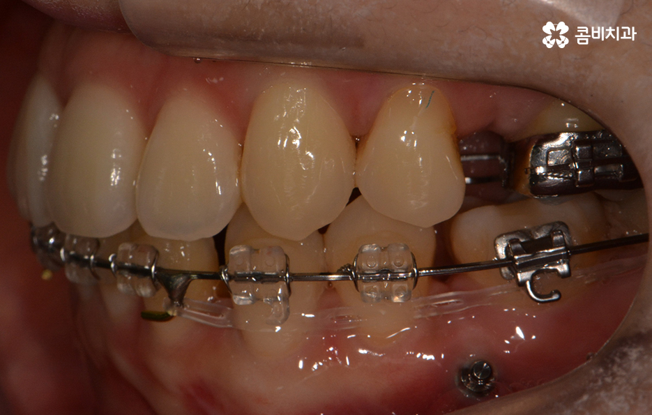 앞니치아교정 자연스러운 결과를 위해 알아둬야 할 점 관련 이미지 8
