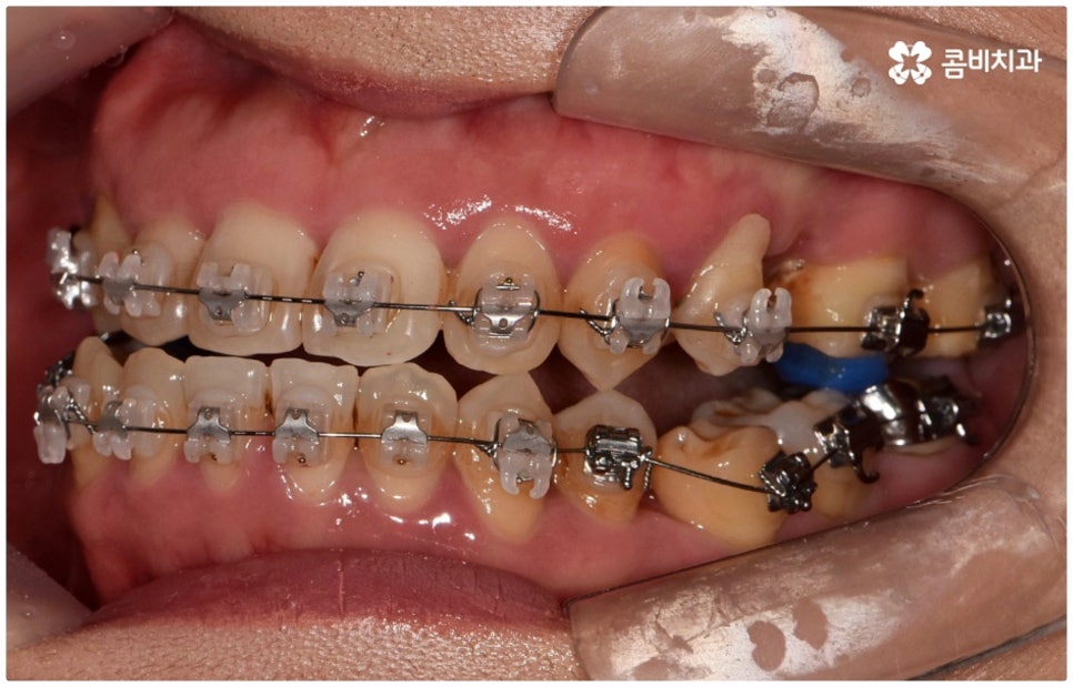 반대교합교정 늦지 않았어요 관련 이미지 8