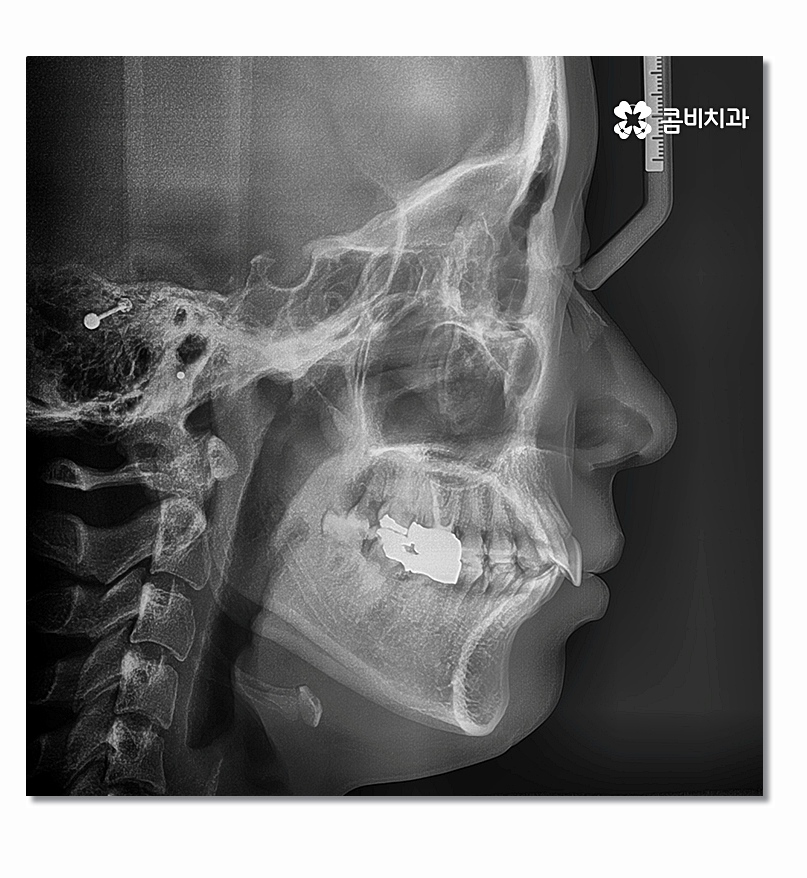 돌출입치아교정 부담이 크게 느껴진다면 관련 이미지 2