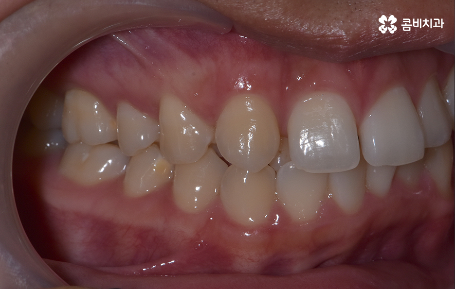 덧니 발치교정으로 교정할 때 치아가 이렇게 이동해요 관련 이미지 3