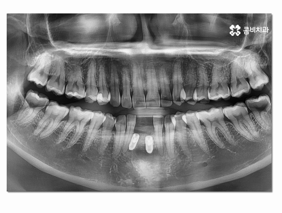 치주염으로 인한 아랫니 임플란트 절차를 알아보면 관련 이미지 6