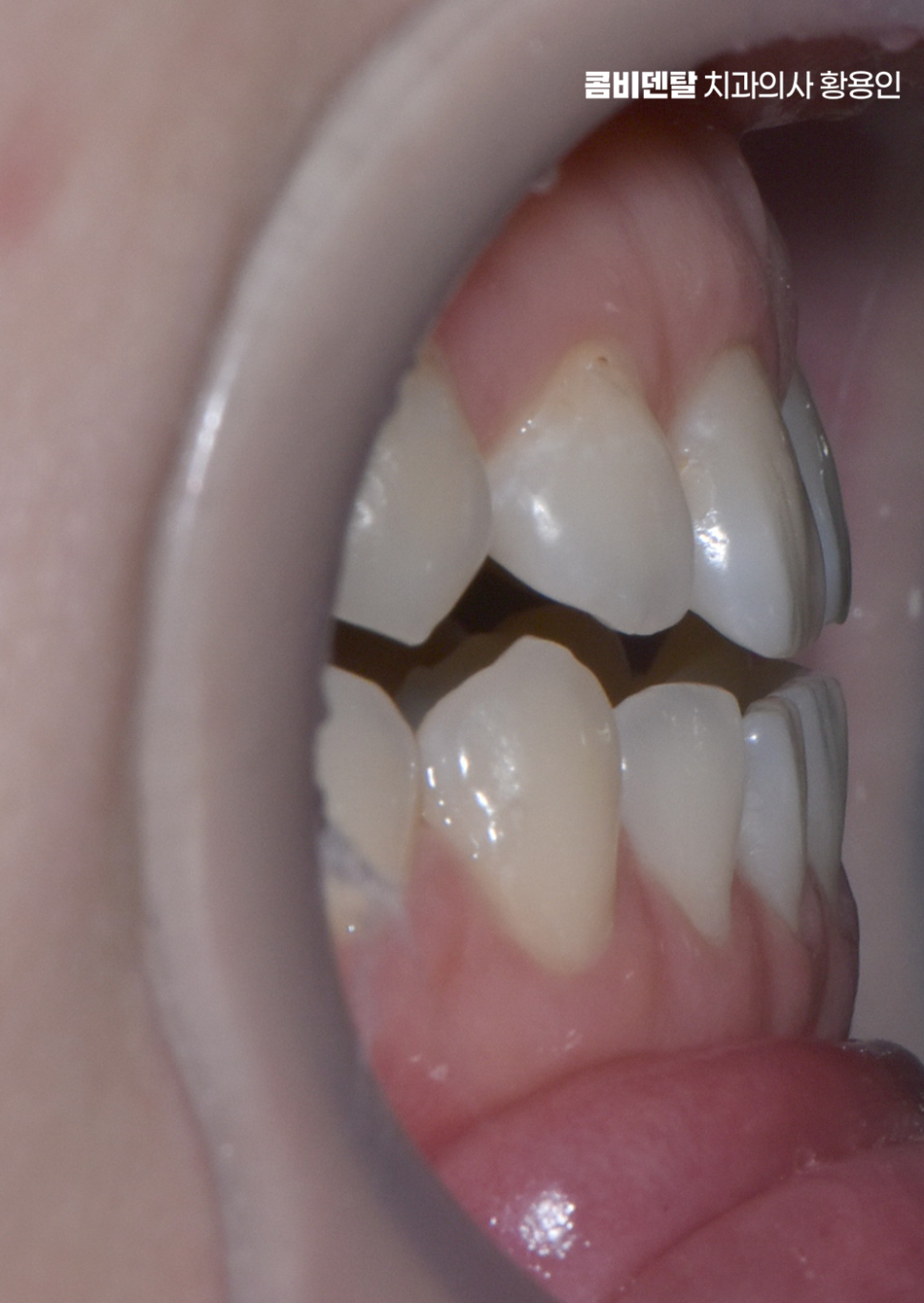 반대교합 치아교정 해결 가능할까 관련 이미지 6