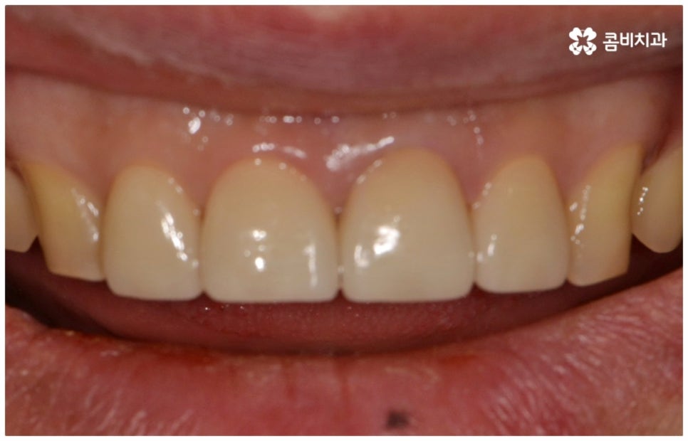 앞니충치치료 어떻게 이뤄지나요 관련 이미지 8
