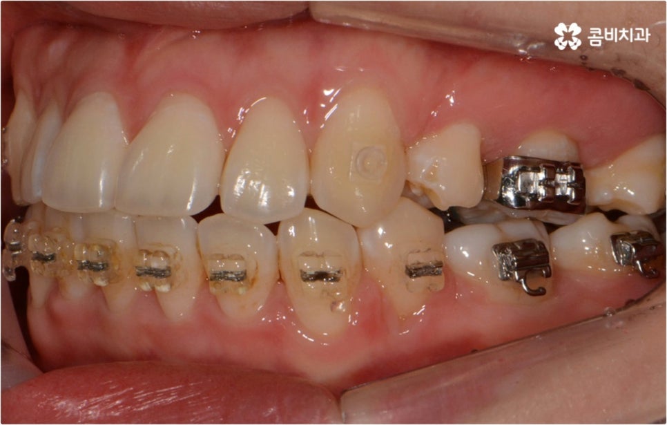 돌출입 치아교정 부모와 아이가 함께 알아봐요 관련 이미지 12