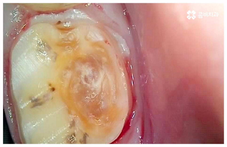 치통이 심할때 어떻게 해야하나요 관련 이미지 10