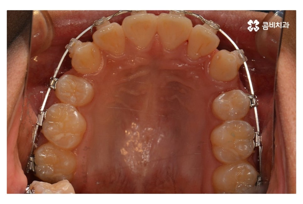 중학생치아교정 세심하게 체크하려면 관련 이미지 10