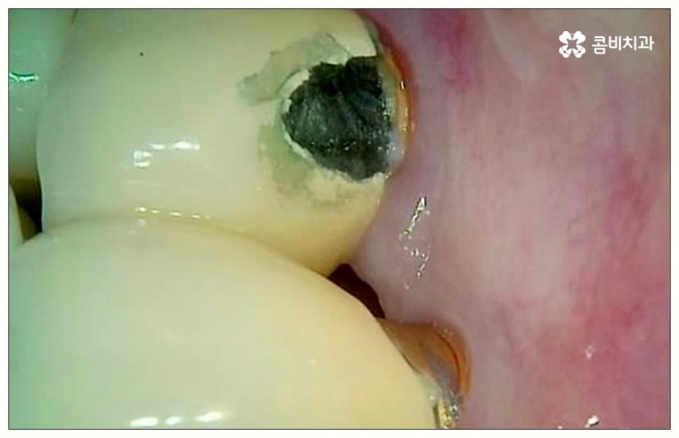 원데이임플란트 어떤가요? 관련 이미지 8